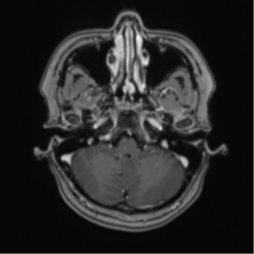 File:Anaplastic astroblastoma (Radiopaedia 55666-62194 Axial T1 C+ 15).png