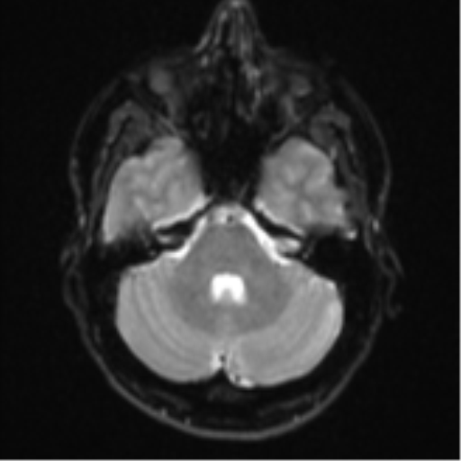 Anaplastic astrocytoma (Radiopaedia 57768-64731 Axial DWI 7).png