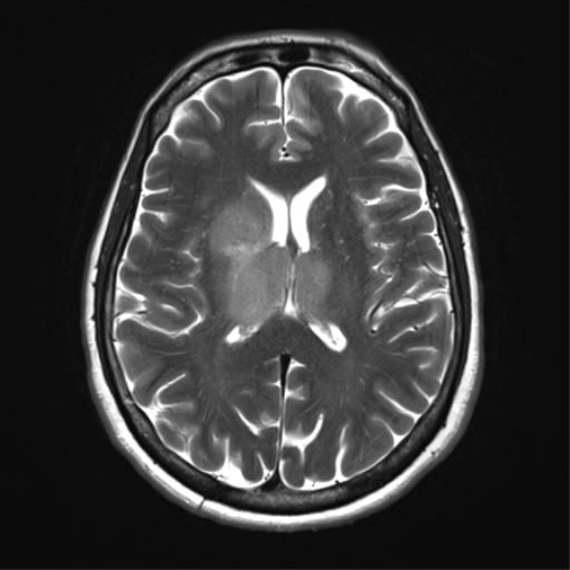 File:Anaplastic astrocytoma - thalamic glioma (Radiopaedia 59709-67115 Axial T2 22).png