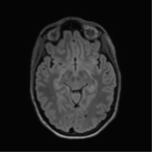 File:Anaplastic astrocytoma IDH mutant (Radiopaedia 50046-55341 Axial FLAIR 22).png