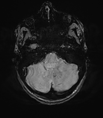 File:Anaplastic astrocytoma IDH mutant (Radiopaedia 50046-55341 Axial SWI 20).png