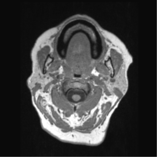 Anaplastic astrocytoma IDH wild-type (pseudoprogression) (Radiopaedia 42209-45276 Axial T1 1).png