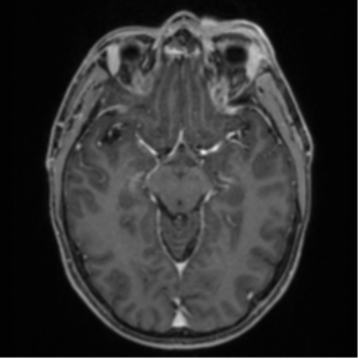 Anaplastic oligodendroglioma with skull fracture (Radiopaedia 74831-85845 Axial T1 C+ fat sat 25).png