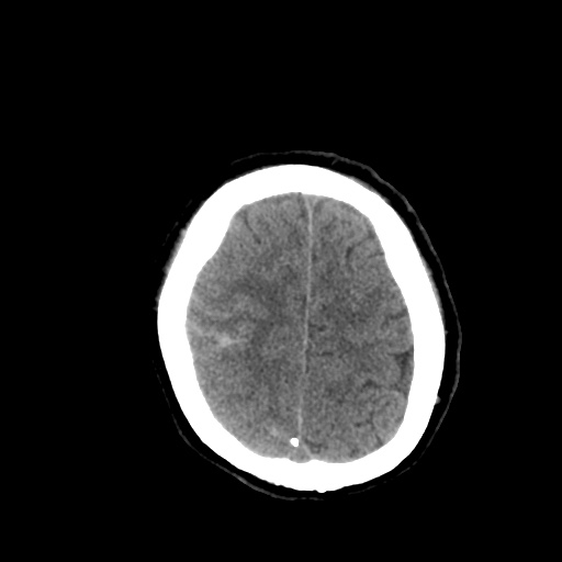 Aneursym related subarachnoid hemorrhage with hydrocephalus (Radiopaedia 45105-49085 Axial non-contrast 42).jpg