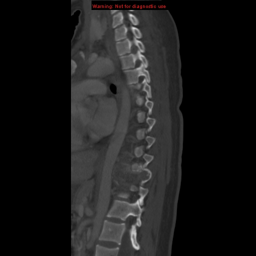 File:Aneurysmal bone cyst (Radiopaedia 9419-10102 Sagittal bone window 12).jpg