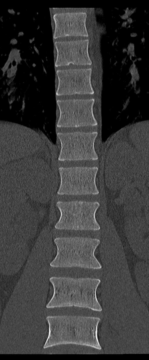 Aneurysmal bone cyst T11 (Radiopaedia 29294-29721 Coronal bone window 24).jpg