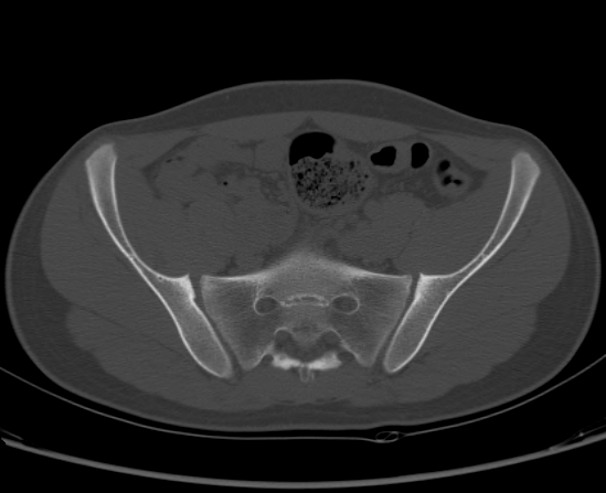 File:Aneurysmal bone cyst of ischium (Radiopaedia 25957-26094 Axial bone window 25).png