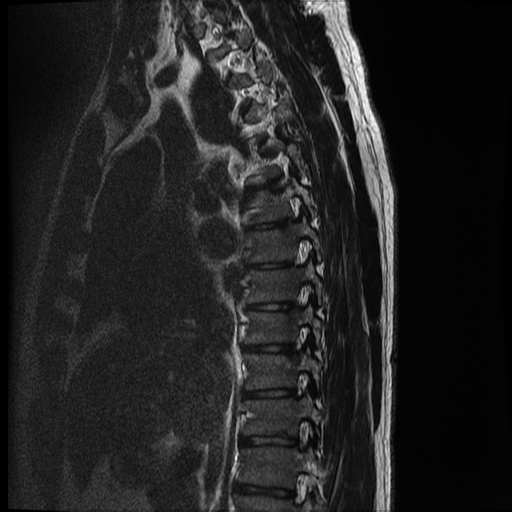 File:Angiolipoma - thoracic spine (Radiopaedia 28242-28479 Sagittal T2 11).jpg