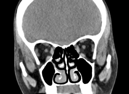 Angular dermoid cyst (Radiopaedia 88967-105790 Coronal non-contrast 33).jpg