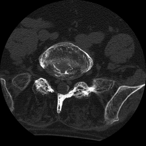 Ankylosing spondylitis complicated by fracture-dislocation (Radiopaedia 33583-34674 Axial non-contrast 138).jpg