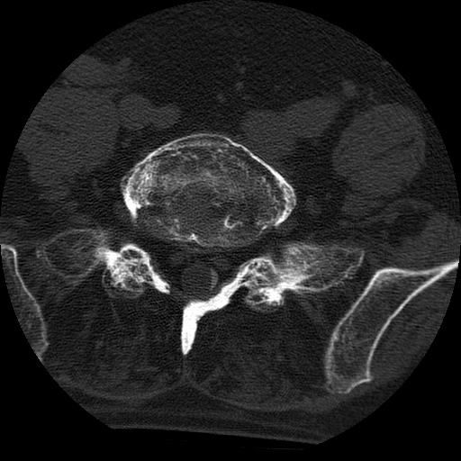 Ankylosing spondylitis complicated by fracture-dislocation (Radiopaedia 33583-34674 Axial non-contrast 140).jpg