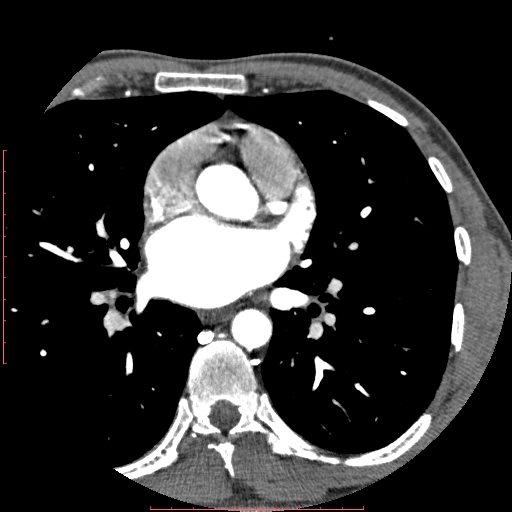 Anomalous left coronary artery from the pulmonary artery (ALCAPA) (Radiopaedia 70148-80181 A 104).jpg