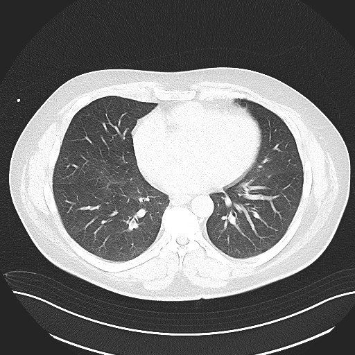File:Anomalous origin of the left coronary artery with malignant course (Radiopaedia 77842-90126 Axial lung window 22).jpeg