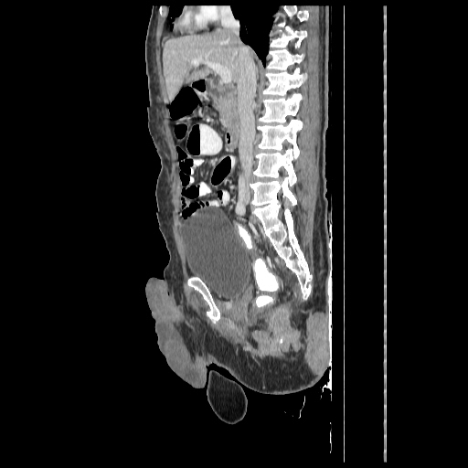 Anorectal carcinoma (Radiopaedia 44413-48064 C 46).jpg