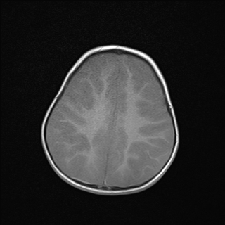 File:Anoxic brain injury (Radiopaedia 79165-92139 Axial T1 20).jpg