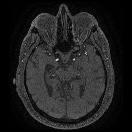 Anterior cerebral artery infarction (Radiopaedia 46794-51323 Axial MRA 84).jpg