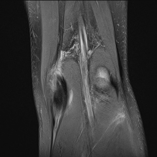 File:Anterior cruciate ligament tear - pediatric (Radiopaedia 62152-70260 Coronal PD fat sat 3).jpg