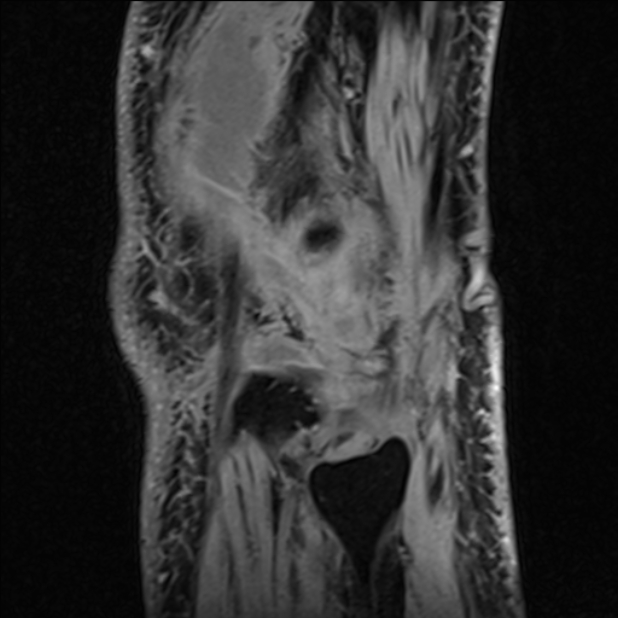Anterior cruciate ligament tear - ramp lesion (Radiopaedia 71883-82322 Sagittal T1 vibe 20).jpg