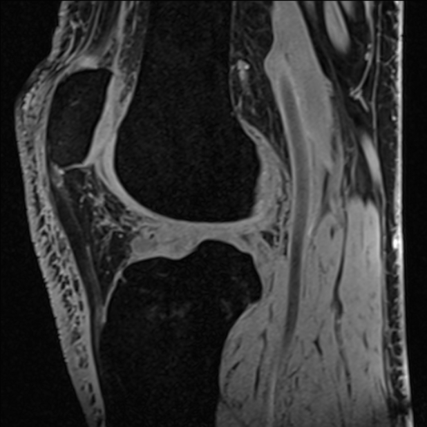Anterior cruciate ligament tear - ramp lesion (Radiopaedia 71883-82322 Sagittal T1 vibe 61).jpg