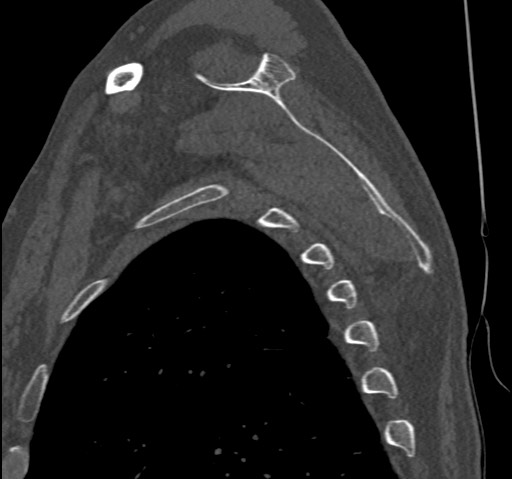 Anterior glenohumeral dislocation with Hill-Sachs lesion (Radiopaedia 62877-71249 Sagittal bone window 49).jpg