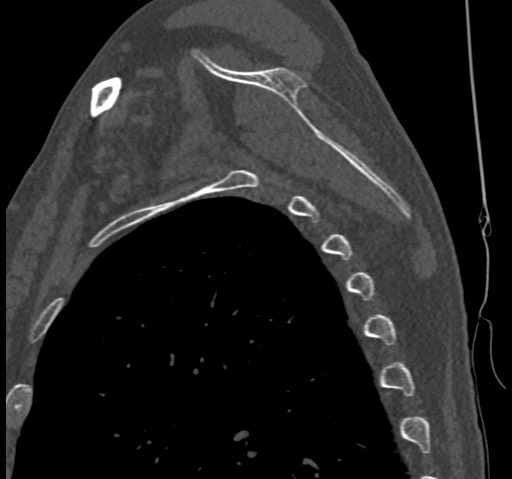 Anterior glenohumeral dislocation with Hill-Sachs lesion (Radiopaedia 62877-71249 Sagittal bone window 53).jpg
