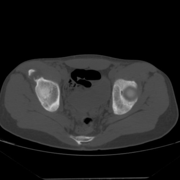 Anterior inferior iliac spine avulsion fracture (Radiopaedia 49469-54627 Axial bone window 33).jpg