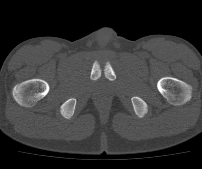 Anterior inferior iliac spine avulsion fracture (Radiopaedia 81312-94999 Axial bone window 67).jpg