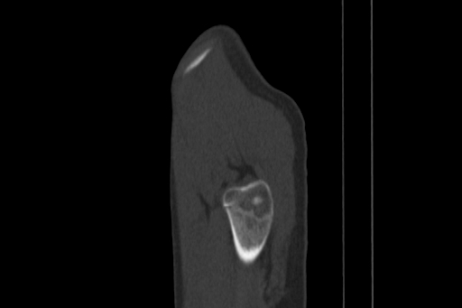 Anterior inferior iliac spine avulsion injury (Radiopaedia 88666-105376 Sagittal bone window 91).jpg
