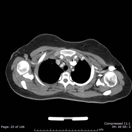 Anterior mediastinal B cell Lymphoma (Radiopaedia 50677-56114 A 13).jpg