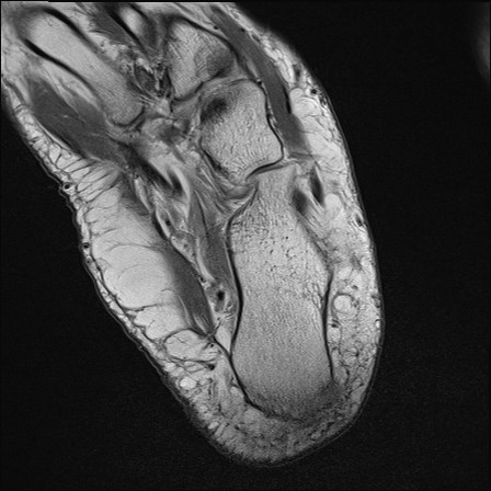 File:Anterior talofibular ligament injury - rupture with soft-tissue impingement (Radiopaedia 38765-40928 Axial PD 31).jpg