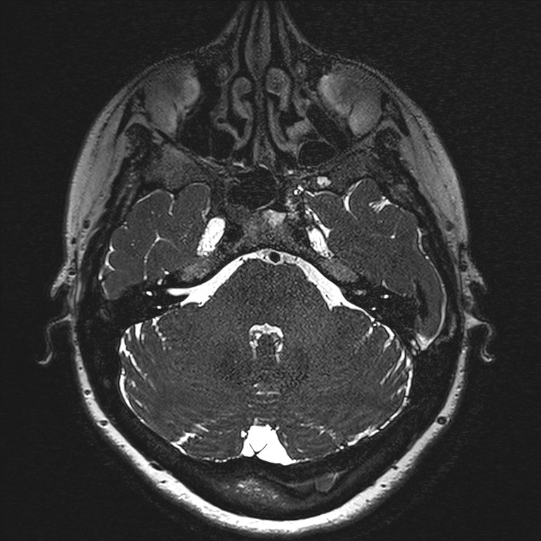 Anterior temporal encephalocele (Radiopaedia 82624-96808 Axial T2 high res 25).jpg