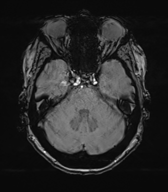 Anterior temporal pole cysts (Radiopaedia 46629-51102 Axial SWI 27).png