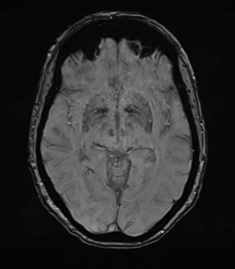 Anterior temporal pole cysts (Radiopaedia 46629-51102 Axial SWI 41).png