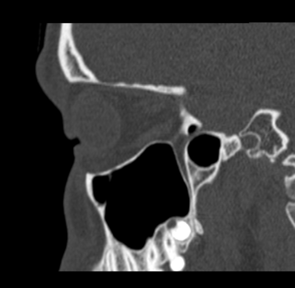 Antrochoanal polyp (Radiopaedia 33984-35202 Sagittal bone window 60).jpg