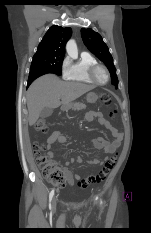 Aortectomy and axillary-bifemoral bypass (Radiopaedia 28303-28545 C 31).jpg