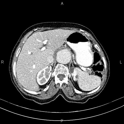 File:Aortic aneurysm and Lemmel syndrome (Radiopaedia 86499-102554 A 22).jpg