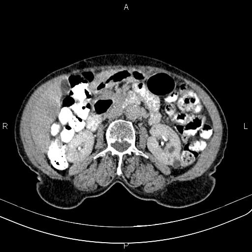 File:Aortic aneurysm and Lemmel syndrome (Radiopaedia 86499-102554 Axial C+ delayed 36).jpg