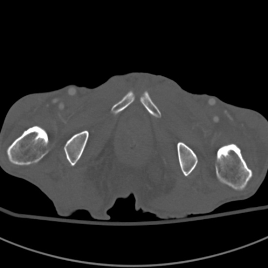 Aortic aneurysm with spinal destruction (Radiopaedia 42301-45410 Axial bone window 121).jpg