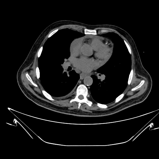 File:Aortic arch aneurysm (Radiopaedia 84109-99365 Axial non-contrast 149).jpg