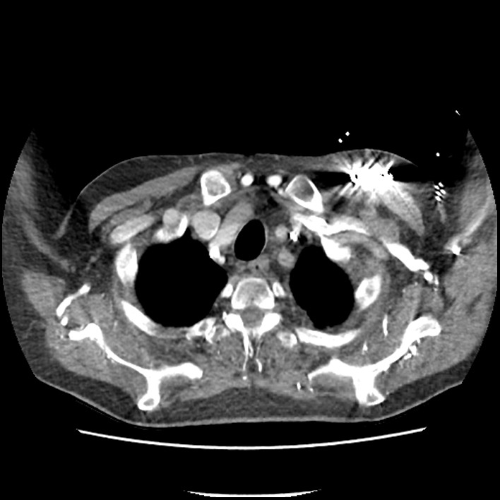 Aortic arch graft infection (FDG PET-CT) (Radiopaedia 71975-82437 A 5).jpg