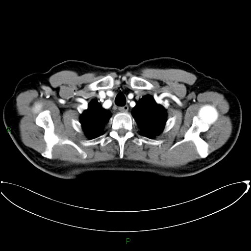 Aortic arch origin of left vertebral artery (Radiopaedia 46327-50737 Axial post contrast 16).jpg