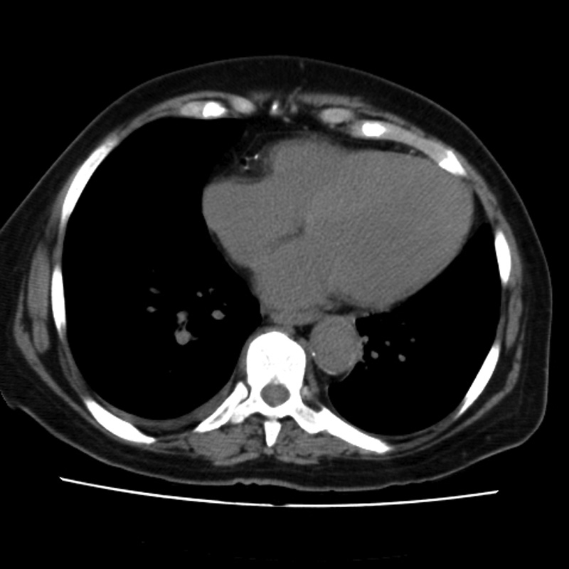 Aortic arch pseudoaneurysm (Radiopaedia 8534-9368 Axial non-contrast 50).jpg