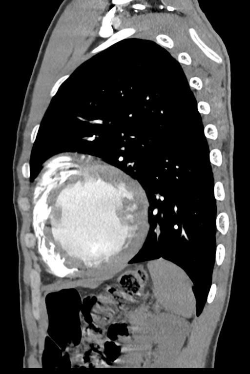 Aortic coarctation with aneurysm (Radiopaedia 74818-85828 B 122).jpg