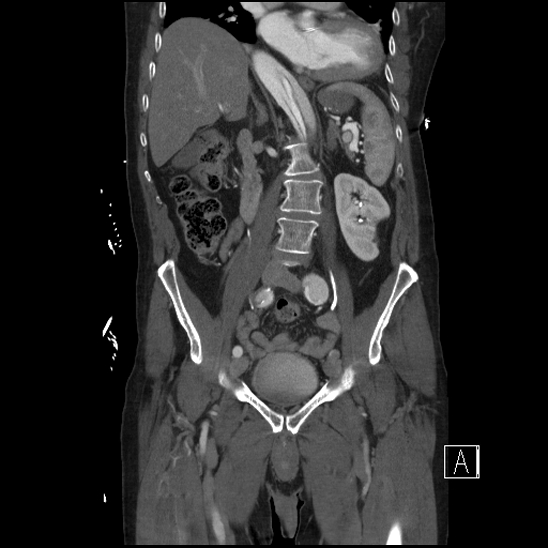 File:Aortic dissection (CTPA) (Radiopaedia 75506-86750 F 35).jpg