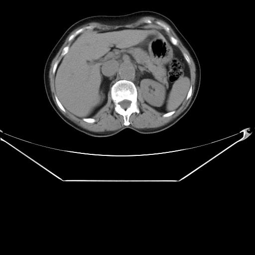 Aortic dissection (Radiopaedia 25350-25604 B 43).jpg