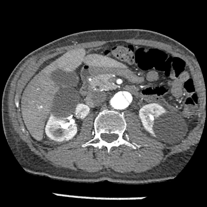 Aortic dissection - DeBakey Type I-Stanford A (Radiopaedia 79863-93115 A 49).jpg