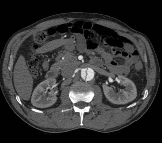 Aortic dissection - Stanford type B (Radiopaedia 73648-84437 A 145).jpg
