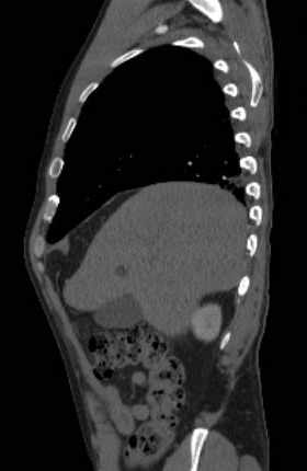 File:Aortic dissection - Stanford type B (Radiopaedia 73648-84437 C 126).jpg