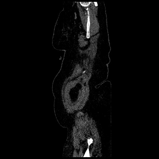 Aortic dissection - Stanford type B (Radiopaedia 88281-104910 C 82).jpg
