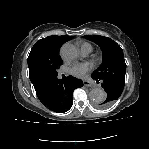 File:Aortic dissection extended to lusory artery (Radiopaedia 43686-47136 Axial non-contrast 16).jpg